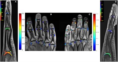 Cartilage Degradation in Psoriatic Arthritis Is Associated With Increased Synovial Perfusion as Detected by Magnetic Resonance Imaging